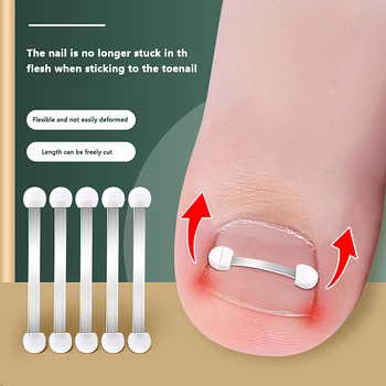Benőtt köröm korrektor fogszabályozó pedikűr Recover beágyazási lábujjköröm kezelés Pro benőtt köröm korrekciós lábköröm tapasz